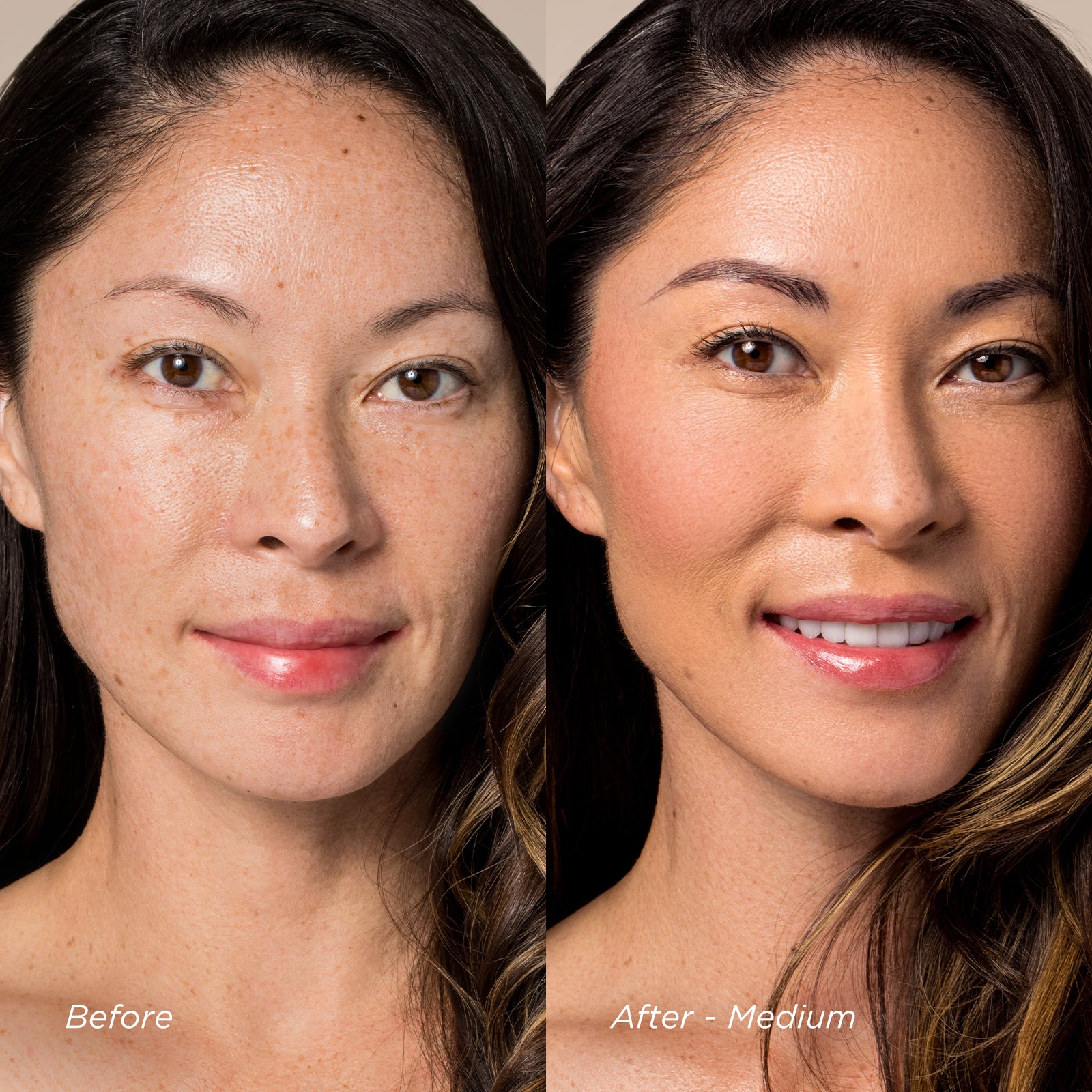 Before and after comparison of a woman's face with 'Before' on the left and 'After - Medium' on the right.