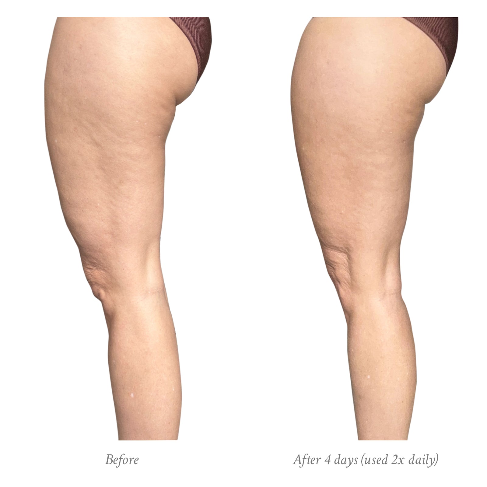 Before and after comparison of legs with visible cellulite reduction over 4 days.
