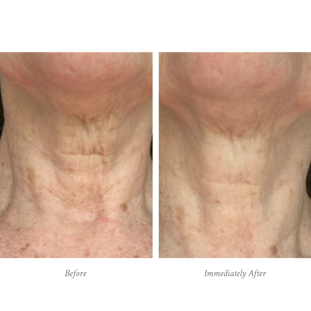 Before and after comparison of neck skin texture, showing visible improvement.