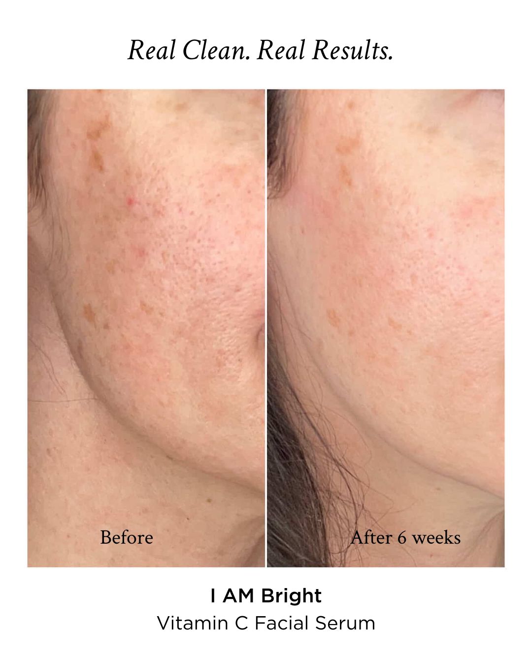 Before and after comparison of skin treatment with 'I AM Bright' Vitamin C Facial Serum.